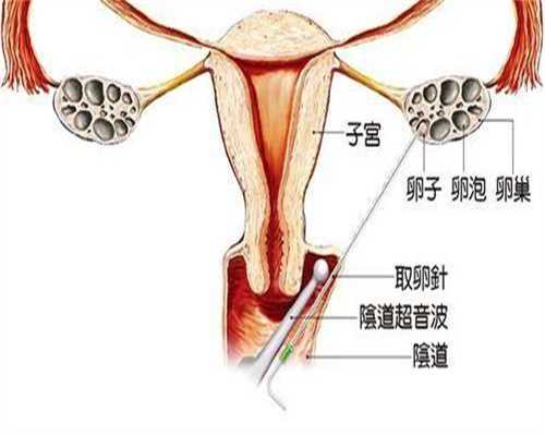 助孕网成功率-产后漏尿怎么恢复？