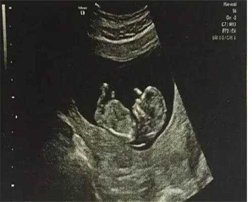 宁波子宫脱垂的治疗：宁波子宫脱垂的治疗医生